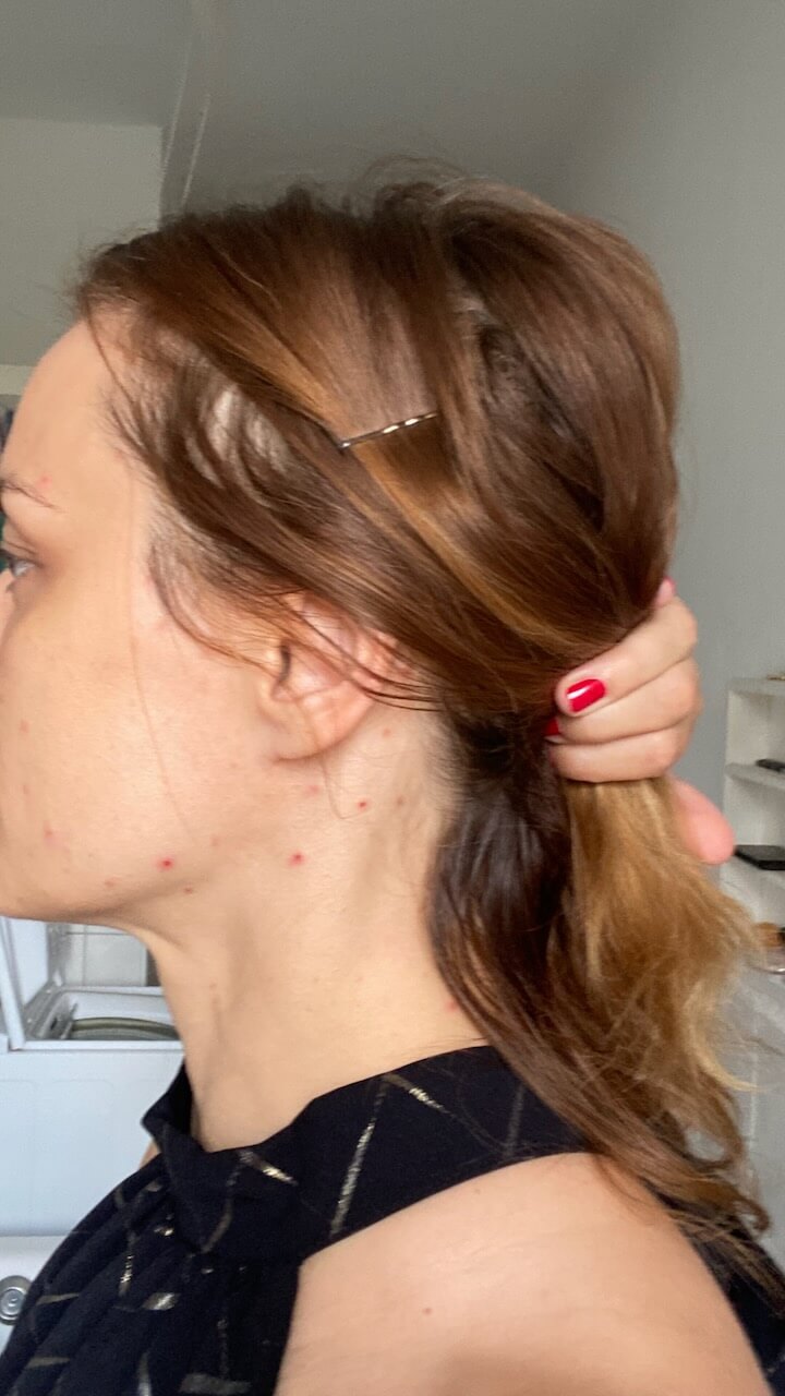 Skin Picking im Bereich von Kiefer und Ohr