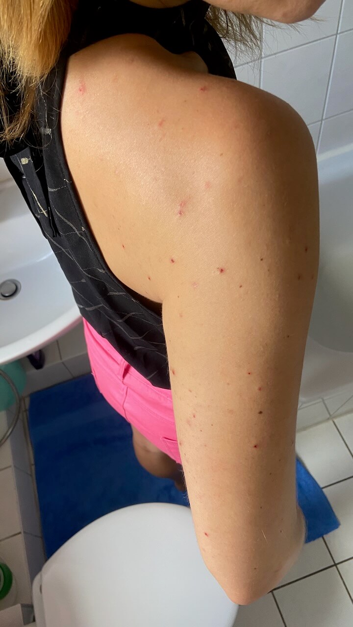 Skin-Picking-Verletzungen am hinteren Oberarm