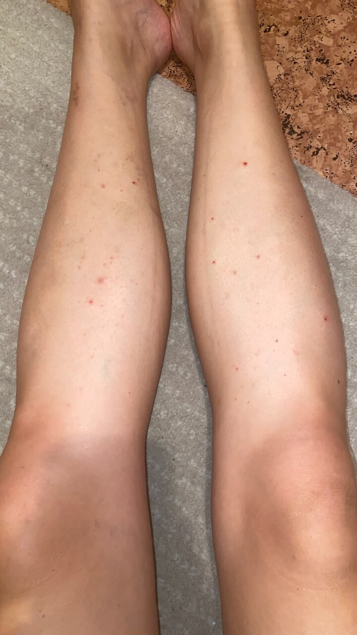Skin Picking am Unterschenkel mit sichtbaren aufgekratzten Hautstellen