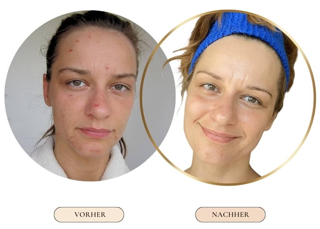 Skin picking vorher nachher reine Haut Skin picking vorher nachher Bild