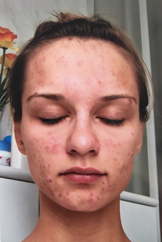 vorher Foto von mir mit Dermatillomanie und ca. 80 wunden Stellen im Gesicht