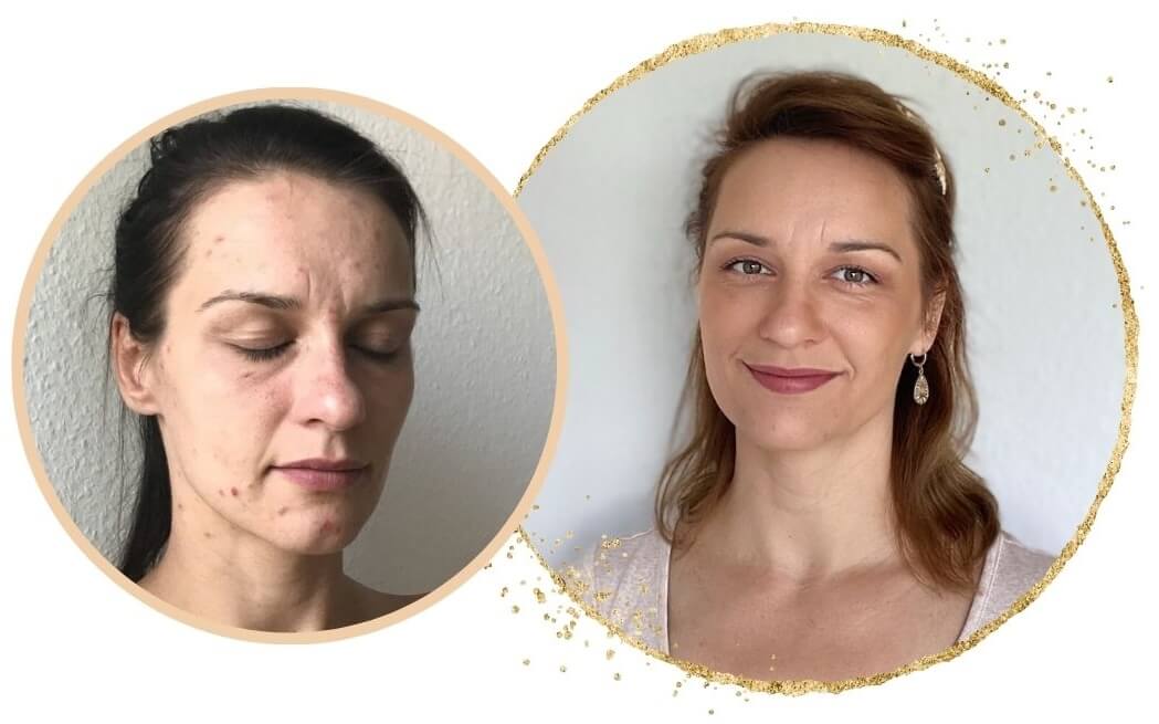 vorher nachher Porträt Sina vorher nachher Skin picking Sina
